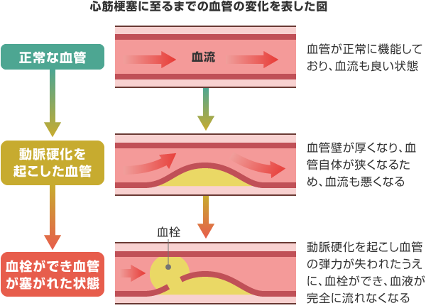 新規13_心筋梗塞(脳卒中)のリスク_1_pc
